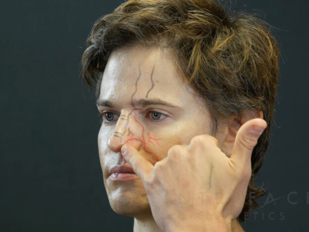 Non-surgical Rhinoplasty - Assessment