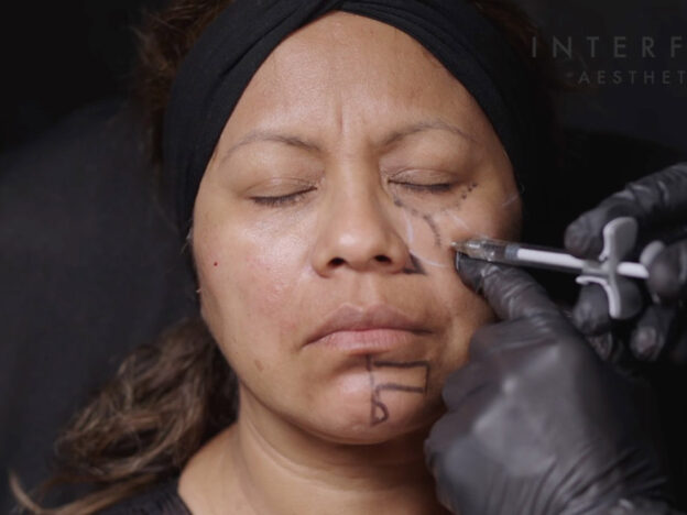 Masterclass - Full Face & Biostimulator