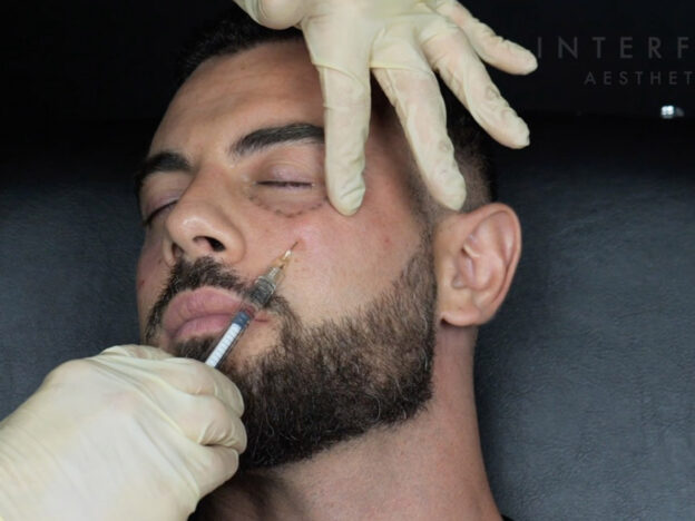 Masterclass - Periorbital Rejuvenation (Male - session 2)
