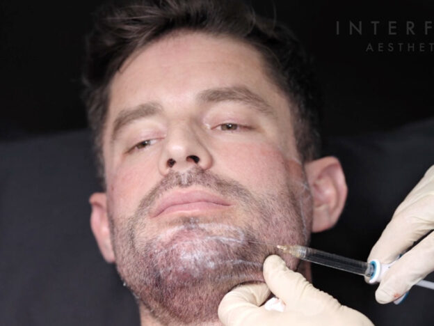 Masterclass - Mid & Lower Face & Biostimulator (Male - session 1)