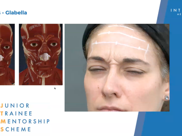 Webinar 4: Facial Anatomy for injectables 2: The Upper face