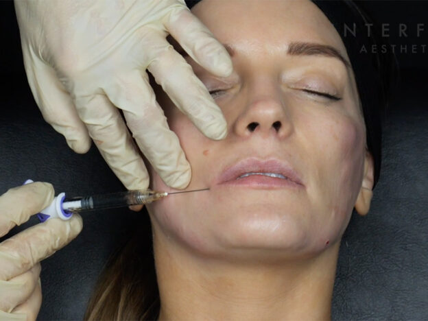 Clinical Demo: Lips - Needle