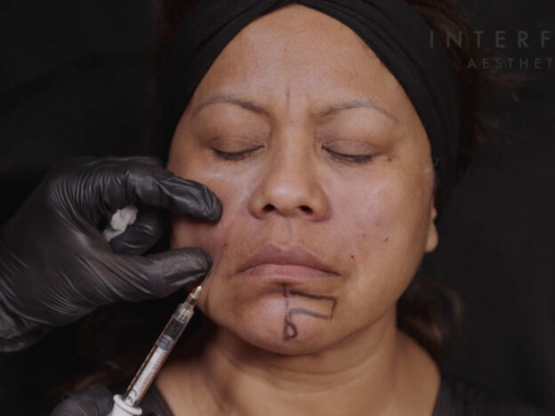Clinical Demo: Nasolabial - Cannula