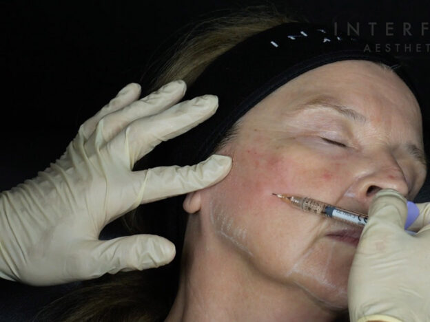 Masterclass - Full Face, HA & Biostimulator (Female)