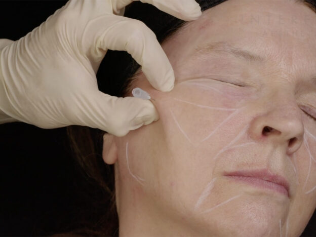 Zygomatic Arch Cannula