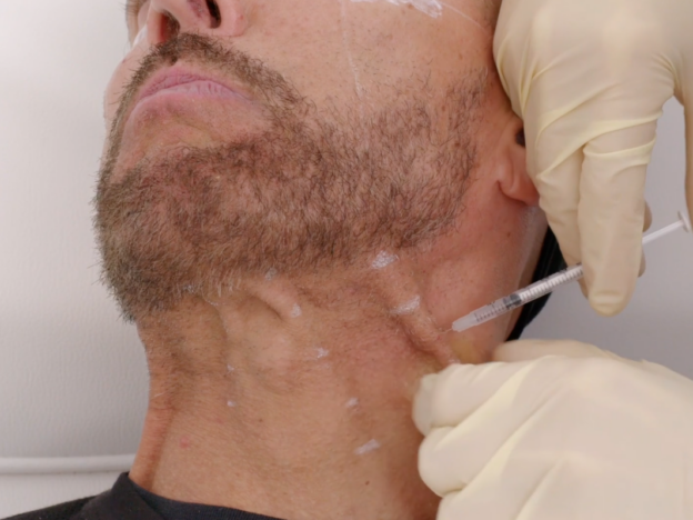 Botulinum Toxin Platysmal Bands