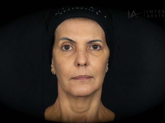 Masterclass - Full Face & Biostimulator (Female)