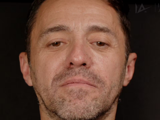 Masterclass - Full Face & Biostimulator (Male) 2